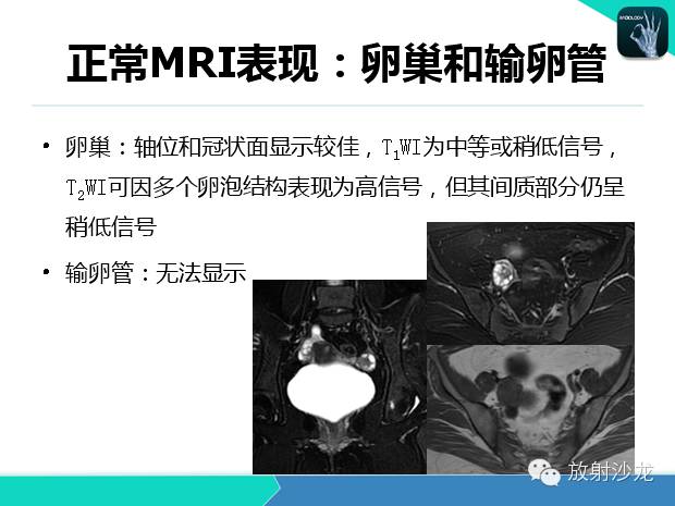 【PPT】宫颈癌MRI诊断在临床中的应用