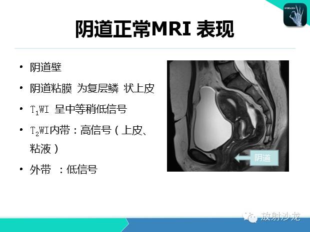 【PPT】宫颈癌MRI诊断在临床中的应用