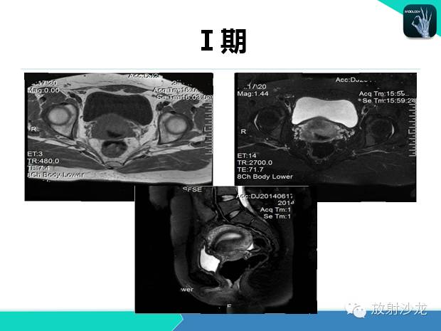 【PPT】宫颈癌MRI诊断在临床中的应用
