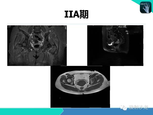 【PPT】宫颈癌MRI诊断在临床中的应用