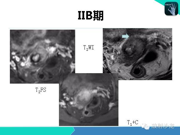 【PPT】宫颈癌MRI诊断在临床中的应用
