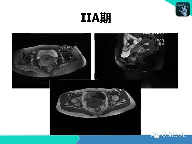 【PPT】宫颈癌MRI诊断在临床中的应用