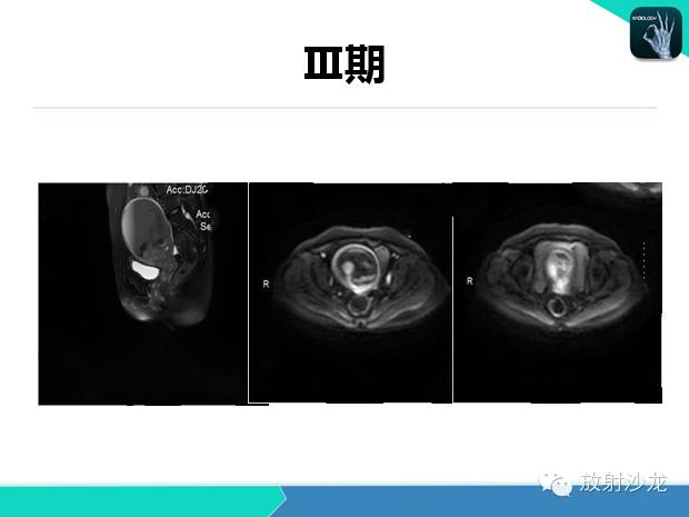 【PPT】宫颈癌MRI诊断在临床中的应用