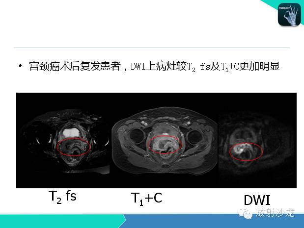 【PPT】宫颈癌MRI诊断在临床中的应用
