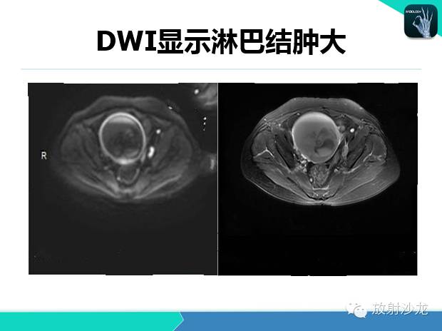 【PPT】宫颈癌MRI诊断在临床中的应用