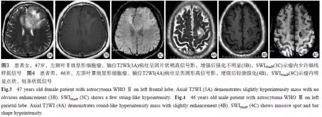 SWI对星形细胞瘤分级及与单发转移瘤鉴别诊断的价值 SWI对星形细胞瘤分级及与单发转移瘤鉴别诊断的价值