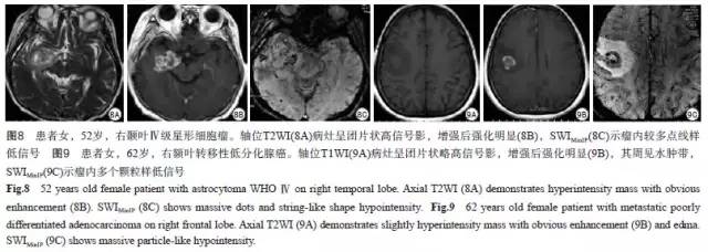 SWI对星形细胞瘤分级及与单发转移瘤鉴别诊断的价值 SWI对星形细胞瘤分级及与单发转移瘤鉴别诊断的价值