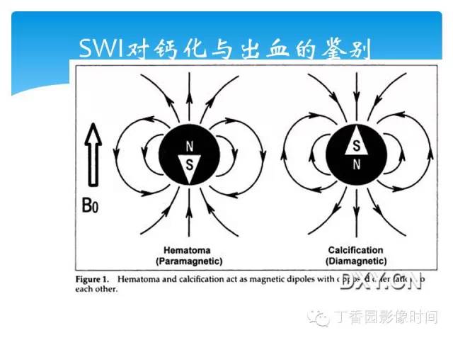 【PPT】SWI的临床应用