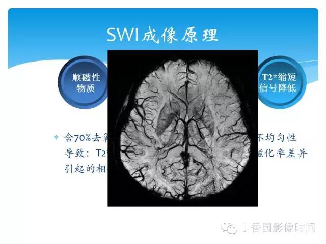 【PPT】SWI的临床应用