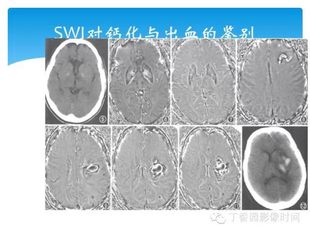 【PPT】SWI的临床应用