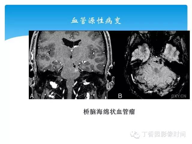 【PPT】SWI的临床应用