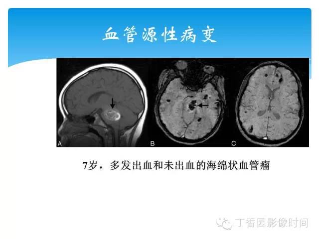 【PPT】SWI的临床应用