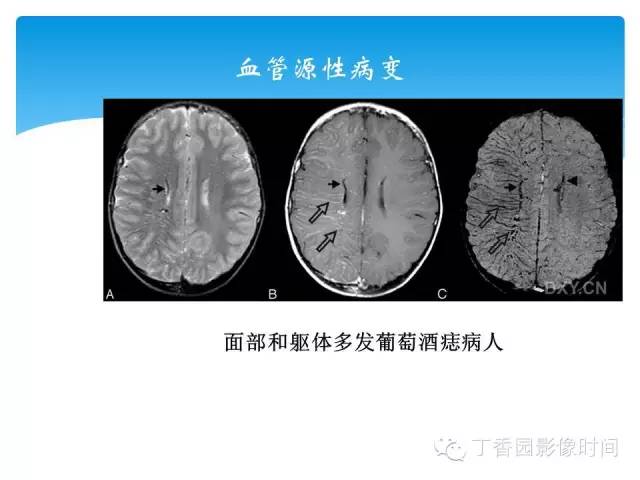 【PPT】SWI的临床应用