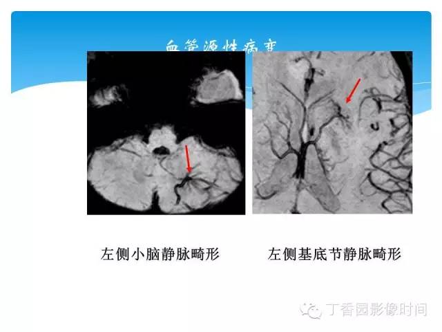 【PPT】SWI的临床应用