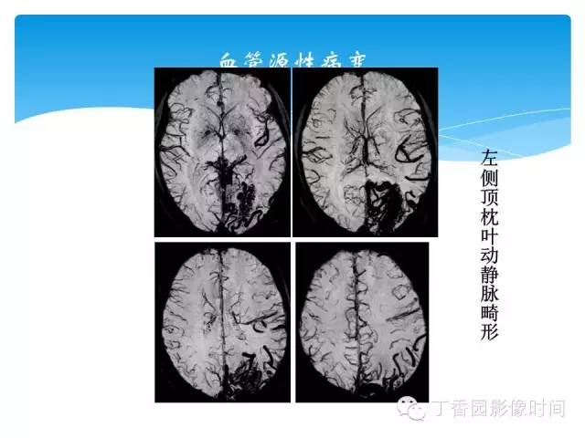【PPT】SWI的临床应用
