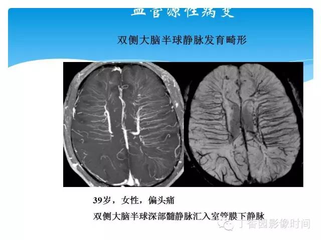 【PPT】SWI的临床应用