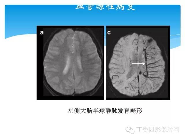 【PPT】SWI的临床应用