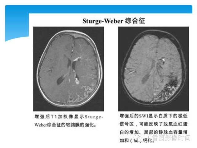 【PPT】SWI的临床应用