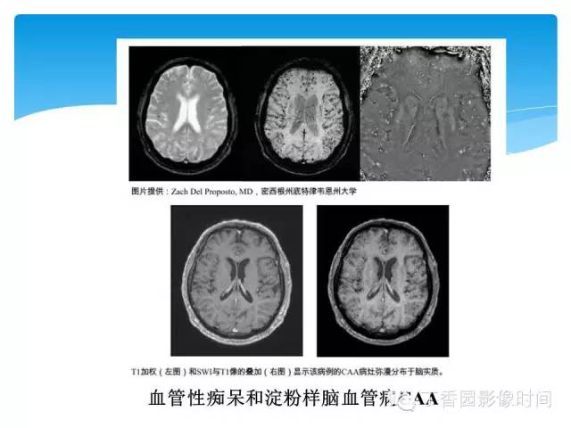 【PPT】SWI的临床应用