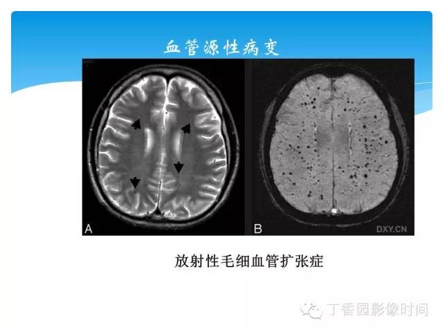 【PPT】SWI的临床应用