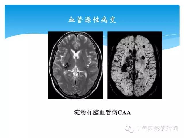 【PPT】SWI的临床应用