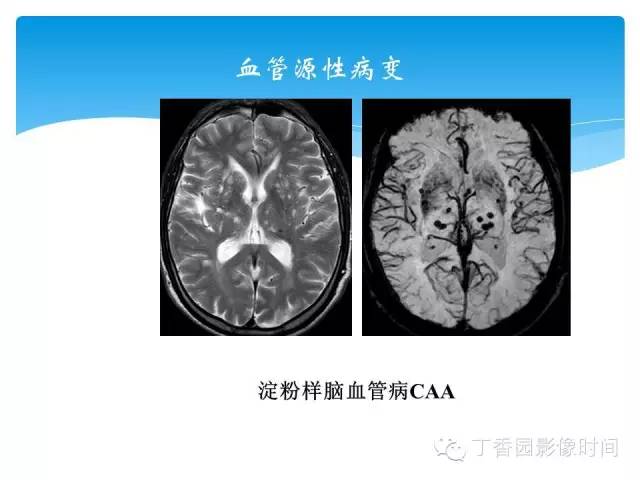 【PPT】SWI的临床应用