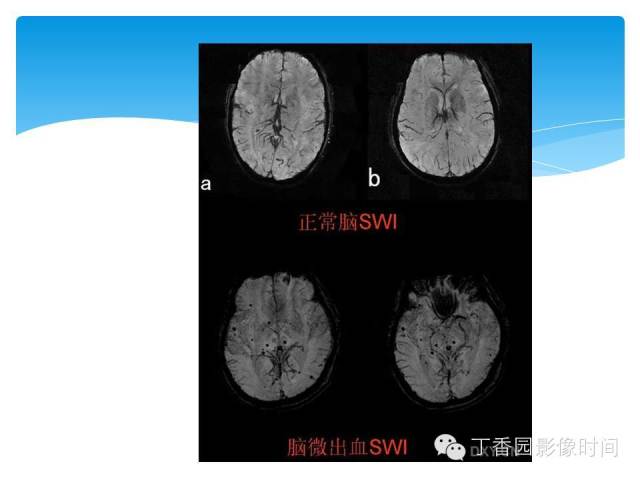 【PPT】SWI的临床应用