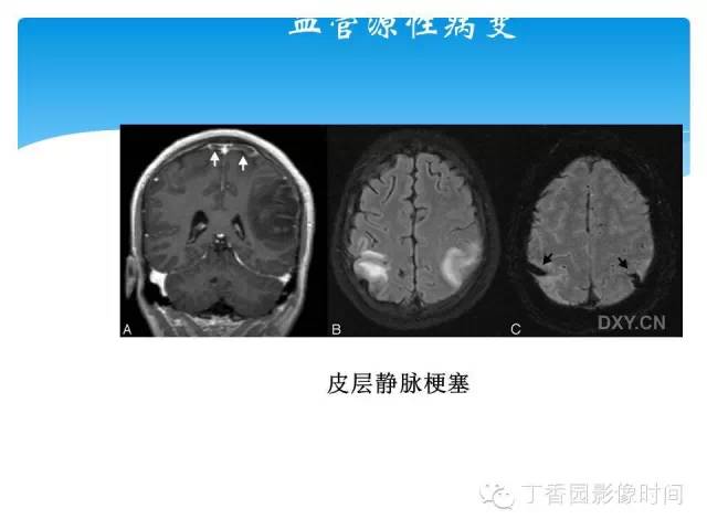 【PPT】SWI的临床应用