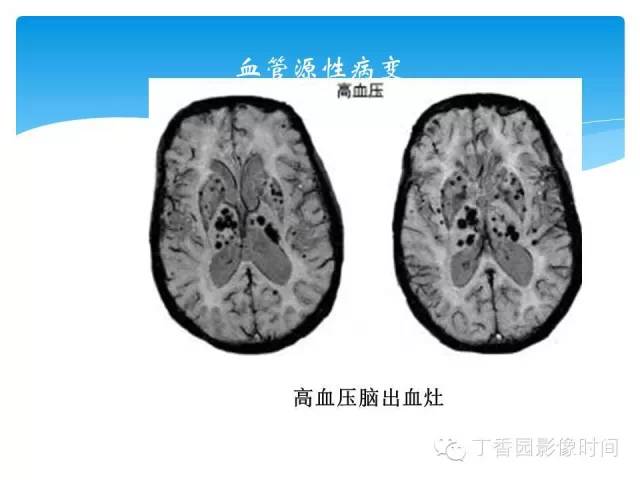 【PPT】SWI的临床应用