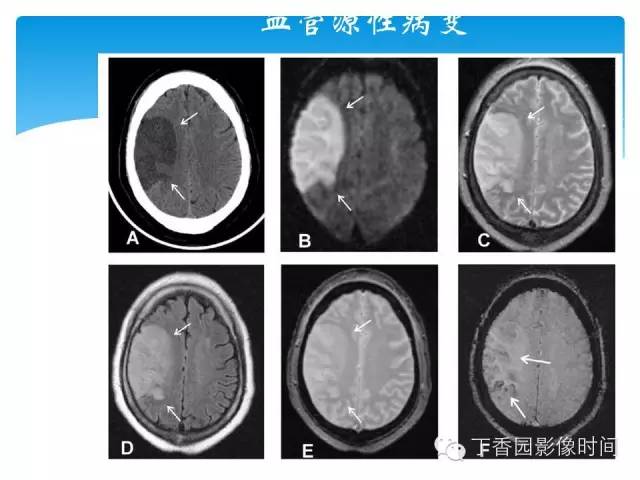 【PPT】SWI的临床应用