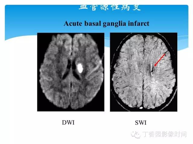 【PPT】SWI的临床应用