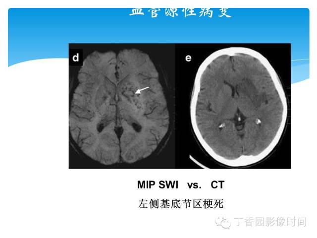 【PPT】SWI的临床应用