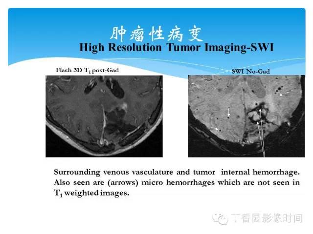 【PPT】SWI的临床应用
