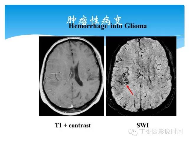【PPT】SWI的临床应用