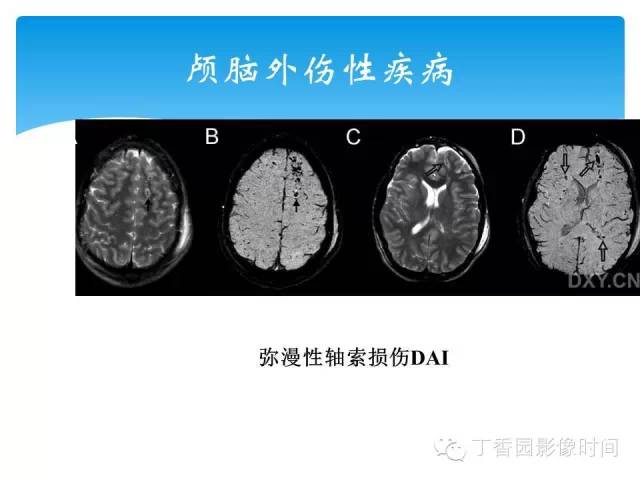 【PPT】SWI的临床应用