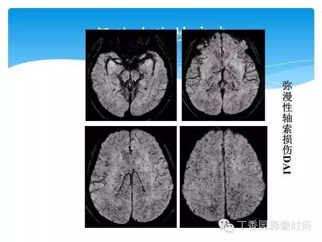 【PPT】SWI的临床应用