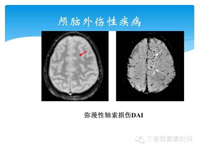 【PPT】SWI的临床应用