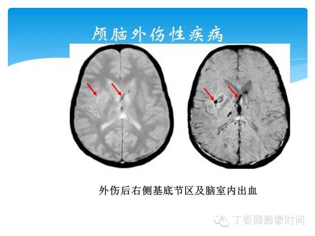 【PPT】SWI的临床应用