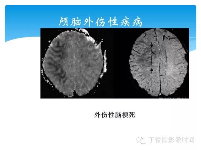 【PPT】SWI的临床应用