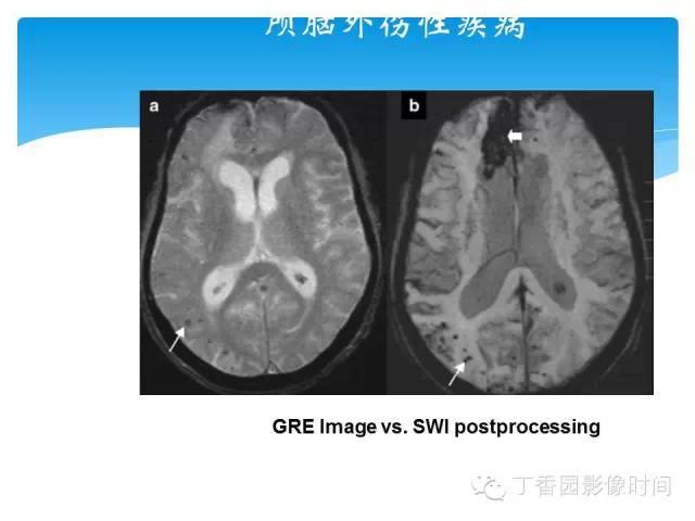 【PPT】SWI的临床应用