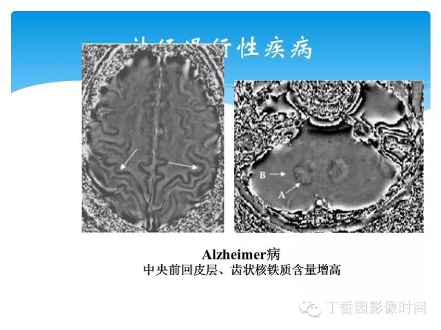 【PPT】SWI的临床应用