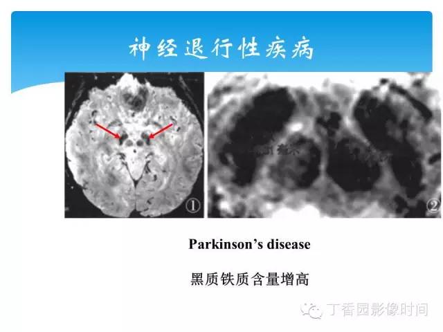 【PPT】SWI的临床应用
