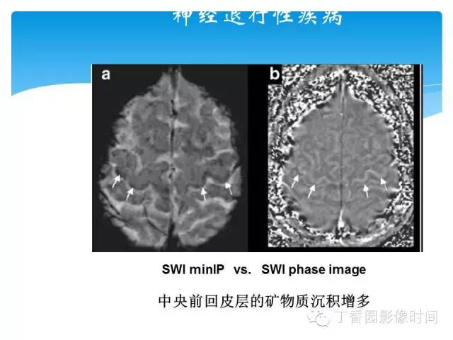 【PPT】SWI的临床应用