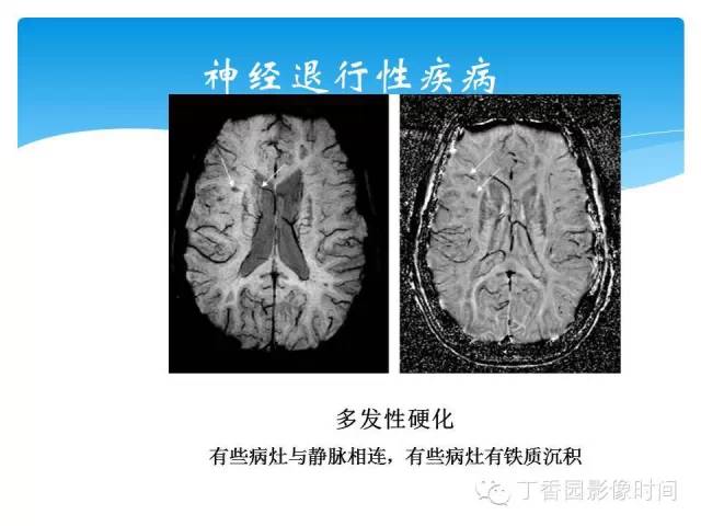 【PPT】SWI的临床应用