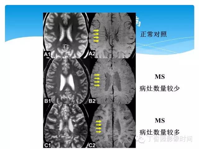 【PPT】SWI的临床应用