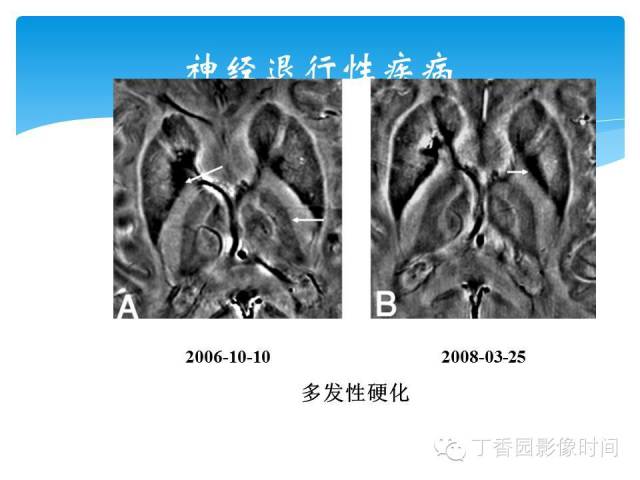 【PPT】SWI的临床应用