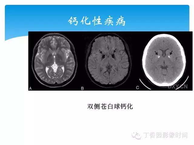 【PPT】SWI的临床应用