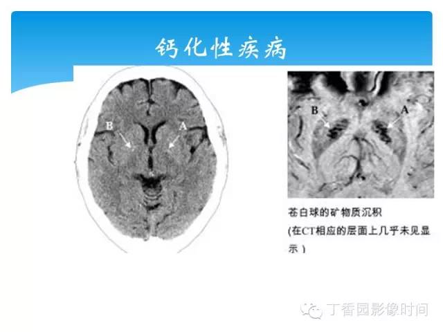 【PPT】SWI的临床应用