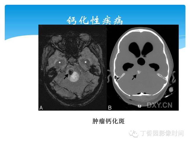 【PPT】SWI的临床应用