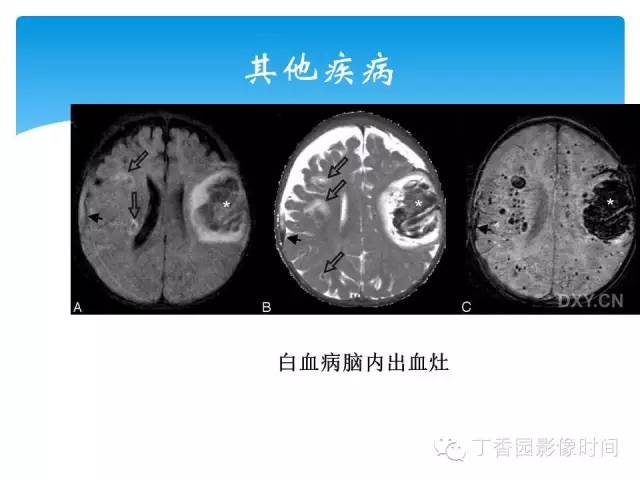 【PPT】SWI的临床应用